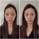 금련산역 3번출구 E/V | 삼송역 구파발 작은얼굴관리, V라인 리프팅으로 확실한 변화!