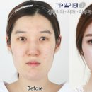 Plastic Surgery before-and-after shots: Should Advertising For It Be Illegal? 이미지