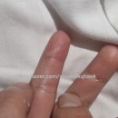 새솔외과의원 | [육아꿀팁] 5살 아이 어린이 화상 치료 후기 공유(동탄/수원)