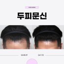 홍대입구역피부과 남성탈모, 두피문신 헤어라인 후기