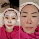 체미안의원 | 코레이지(Corage)레이저 생생후기 체미안 부천점