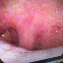 아인 | 아인병원 편도절제수술 후기, 편도 농양이라니! (아인병원 이비인후과)