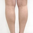 미케이의원 | (강남)미케이의원 아이라인반영구+종아리보톡스 내돈내산 후기