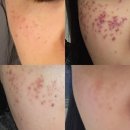 1 | 보령 주근깨 기미 잡티제거 레이저 내돈내산 후기, 1회차