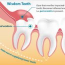 사랑니 통증 사랑니 발치 후 사랑니 염증 사랑니 발치해야 하나? 이미지