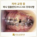 미니스크류 (미니임플란트), 꼭 심어야 할까? 통증부터 관리법까지 구리치아교정 아너스교정치과 총정리!