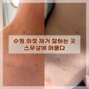 장안제일약국 | 수원 피부관리샵 스무살에 머물다 수원스타필드점 쥐젖제거