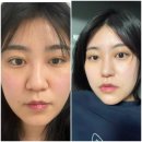 ABC성형외과의원 | 강남 닥터미 노즈빔+콧볼축소+메가덤 1년 변화 찐후기