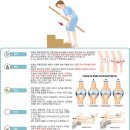 퇴행성 무릎관절염 (Gonarthrosis) 이미지