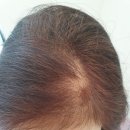 하니뷰티 | 탈모 고민 줄어드는 두피케어센터 불광동 하니루비셀 뷰티랩 후기