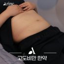 압구정한의원 | 압구정역 한의원 고도비만 다이어트 후기 살빠지는차 부족했다면