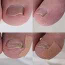 고바우신발 | 천안 내성발톱 교정 후기｜걷기만 해도 찌릿했던 발톱, 첫 관리 후 변화