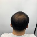5721 | 남자정수리탈모로 고민 중인 우리 아빠, 대구두피문신 받은 후기!