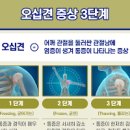 어깨오십견 증상 오십견 원인 치료 이미지