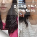 현대치과기공소 | 두통보톡스 내돈내산 후기 😊 송도보톡스 직접 받아본 경험