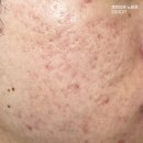 하늘땅한의원 | 노원여드름흉터치료 후기 케이스 많은 곳 후한의원