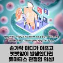 도봉-도봉-2120 | 손가락류마티스 관절염 증상, 조기발견이 중요한 이유 [손가락 류마티스 관절염 증상]