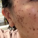 순한의원 | 편평사마귀 제거후기(내돈내산)-사려니의원