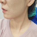 스노우의원 전주점 | 전주 스노우의원 신시가지 피부과 사각턱 보톡스 후기