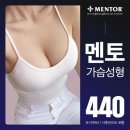청담그룹의원 | 400만원 날리게 됐어요. | 1년후 비포 애프터 가슴성형수술 리얼 후기 비용, 없던게 생기니까 너무 좋아💖