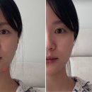 대구 동성로 피부과 대구올리지오 600샷 내돈내산 후기 | 가격, 통증,전후