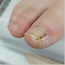 에이(A)플러스 | 인천 학익동 인하대역 내성발톱 에이풋케어 방문 후기