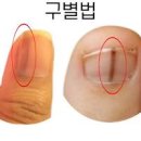 손톱에검은세로줄 엄지손톱 흑색종 병원 가야 하나 이미지