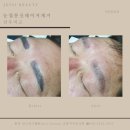 (주)이푸른 | 대구눈썹문신제거 반영구눈썹 잔흔제거잘하는곳추천 붉은잔흔 푸른잔흔눈썹제거후기 주씨뷰티