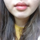 해성대학약국 | 매복사랑니발치후기 (1~2일차) #주절주절 일기