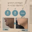 가수원상점가 | 대전 가수원동 이중턱관리 두턱 남자 1회차 후기 (루모어부티끄 라인젯)