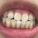 전치과의원 | 광주 그랜드치과의원 치아미백 실제 내돈내산후기 (결혼준비) 사진후기있음