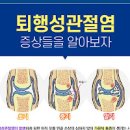 류마티스 관절염 퇴행성 관절염 원인 초기 류마티스관절염 퇴행성관절염 차이점 방법 이미지