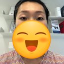 우주약국 | 내돈내산 쌍수후기 자연유착 눈매교정 같이 했어요 사진많음주의