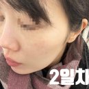 이수역 7호선 | [리뷰] 이수역 피부과 리쥬란 2cc 연어마냥 또 맞은 후기
