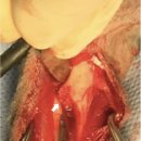 Radioulnar ischemic necrosis에 의한 pathological radial fracture. 이미지