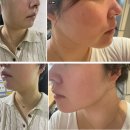 [대구리프팅성형외과] 이중턱 인모드 fx 후기, 가격, 통증, 부작용, 멍빠지는 시기