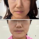 아미뷰티(AMI BEAUTY) | 대구 온다리프팅 효과 가격 티리온X 12만줄 솔직 후기