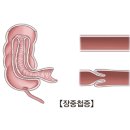 장중첩증(Intussusception) 이미지