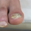 [옥정]명품파츠 셀프네일아트 | 양주 옥정 발톱무좀 굿네일에서 깔끔히