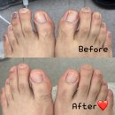 굿모닝대흥병원 앞 | 하이푸스 마포대흥점 : 발각질, 문제성발톱, 내성발톱 마포 발케어 신세계 솔직후기