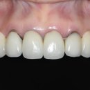 올스마일치과의원 | 수원치과 앞니 크라운 교체 재치료 고려사항과 치과 선택 기준, 가격, 수명, 후기
