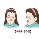 크루존 증후군[Crouzon syndrome]유전질환 이미지