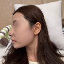 ㈜심플라인[제2공장] | 자가늑 코재수술[상담부터 2달차 후기까지] 자가늑연골 흉터·통증