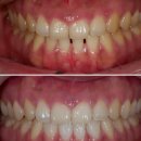 수원21세기치과의원 | 수원치아미백? 돈쓰지 마세요. 하얗게 만드는 5가지 방법[가격, 후기, 비교]