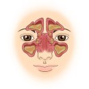 만성 부비동염(Chronic rhinosinusitis) 귀코목 질환이란? 이미지