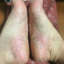 공신약국 | 한미 유리아크림 액상형 스프레이 병행 루틴 후기