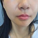또팔자 | 포레스트리프팅 팔자 리프팅후기｜필러 비교·통증·효과·유지기간 정리