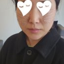 흑자 제거 비용 상담 후 오타모반 치료했어요