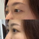 압구정역 성형외과 짝눈 쌍커풀 퀵매몰 일주일 후기