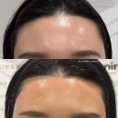 부평시장역4번출구약국 | 부평시장 왁싱 잘하는 유니르왁싱에서 헤어라인&amp;인중왁싱 받은 후기